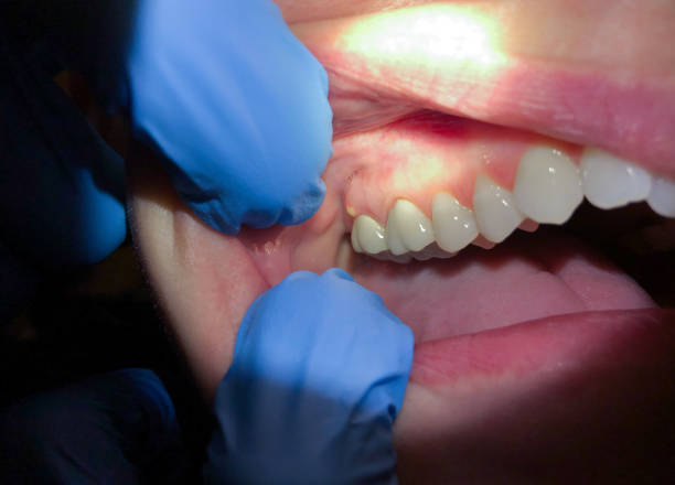 Best Emergency Tooth Extraction in Riverside, UT